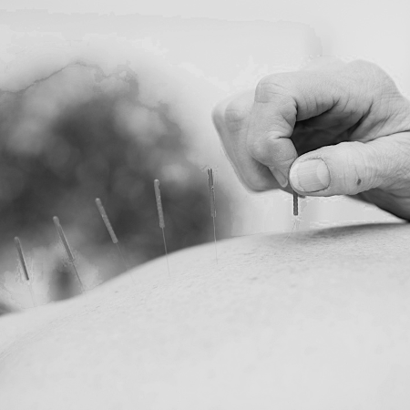 Akupunkturbehandling med sterila nålar på en klinik i Göteborgs centrum.